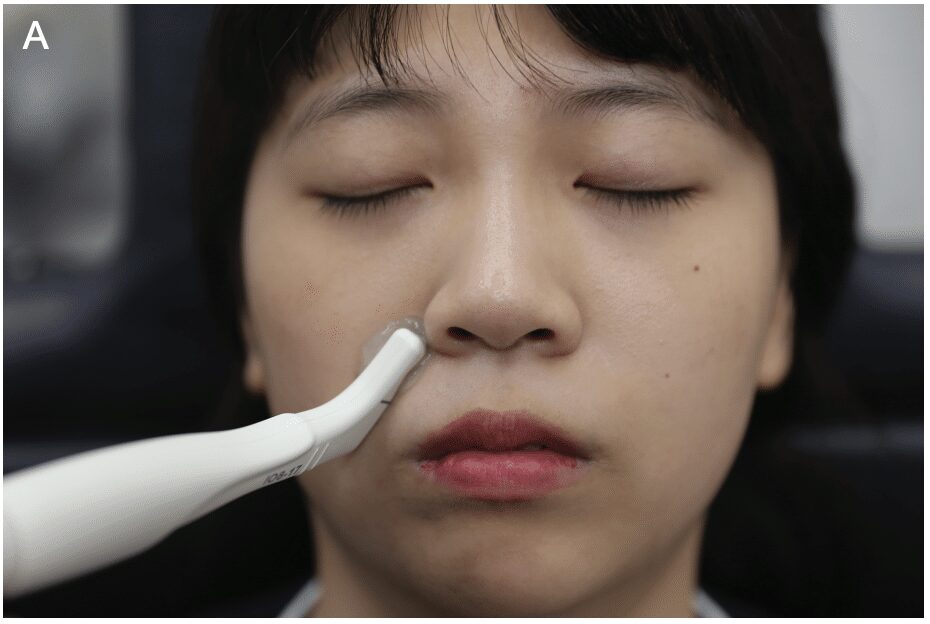 Image filler nasolabial fold A Safe Doppler Ultrasound–Guided Method for Nasolabial Fold Correction With Hyaluronic Acid Fillerfig.1 A 金蘋果美學診所｜歐家宏醫師