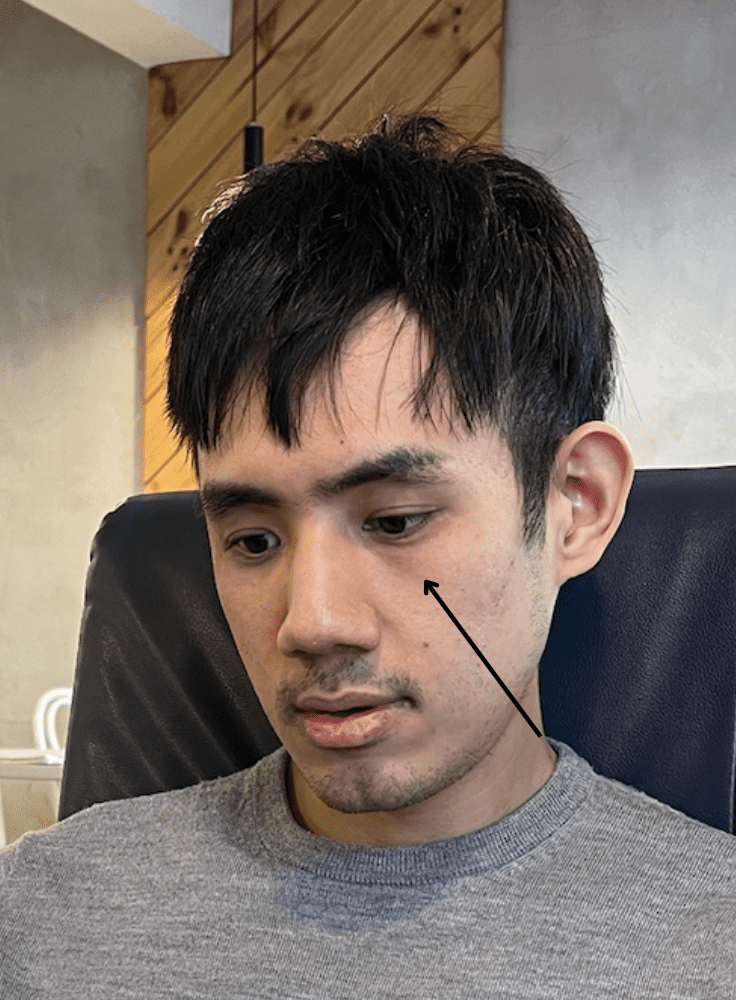 淚溝醫美推薦打什麼?3種類型淚溝改善千萬別搞錯 1 淚溝