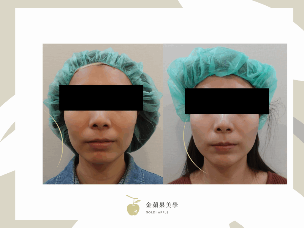 臉頰凹陷醫美費用:5種材質價格比較 3 童顏針臉頰凹陷