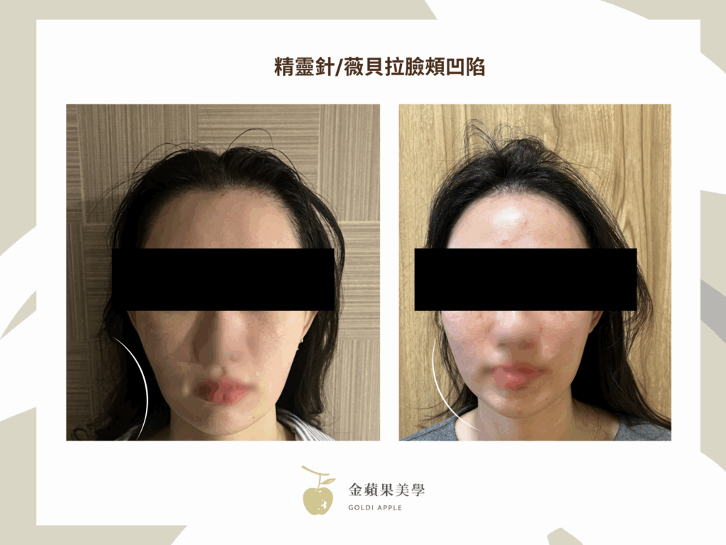 臉頰凹陷醫美費用:5種材質價格比較 4 精靈針臉頰凹陷 金蘋果美學診所|歐家宏醫師
