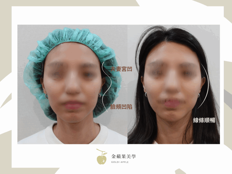 臉部線條不順