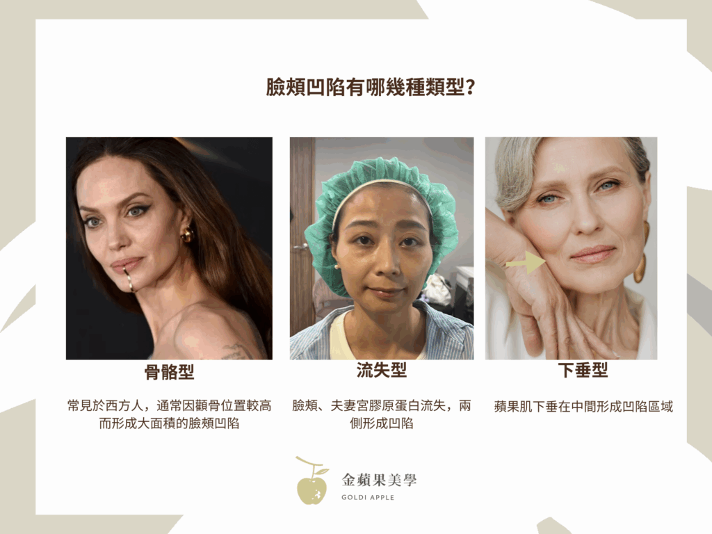 臉頰凹陷該如何補救?玻尿酸、童顏針、薇貝拉、精靈針4種材質比一比 3 臉頰凹陷原因