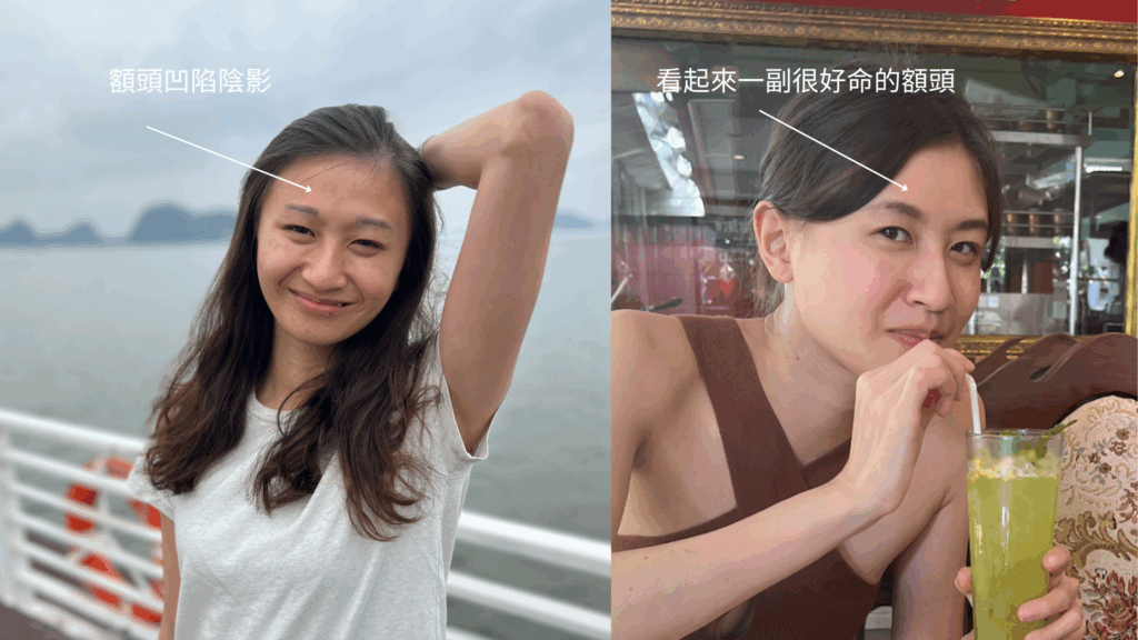 額頭凹陷最佳解:洢蓮絲額頭黃金6步驟 1 額頭凹陷 金蘋果美學診所|歐家宏醫師親自諮詢|無痛玻尿酸|埋線拉提|肉毒|微整|Goldi Apple
