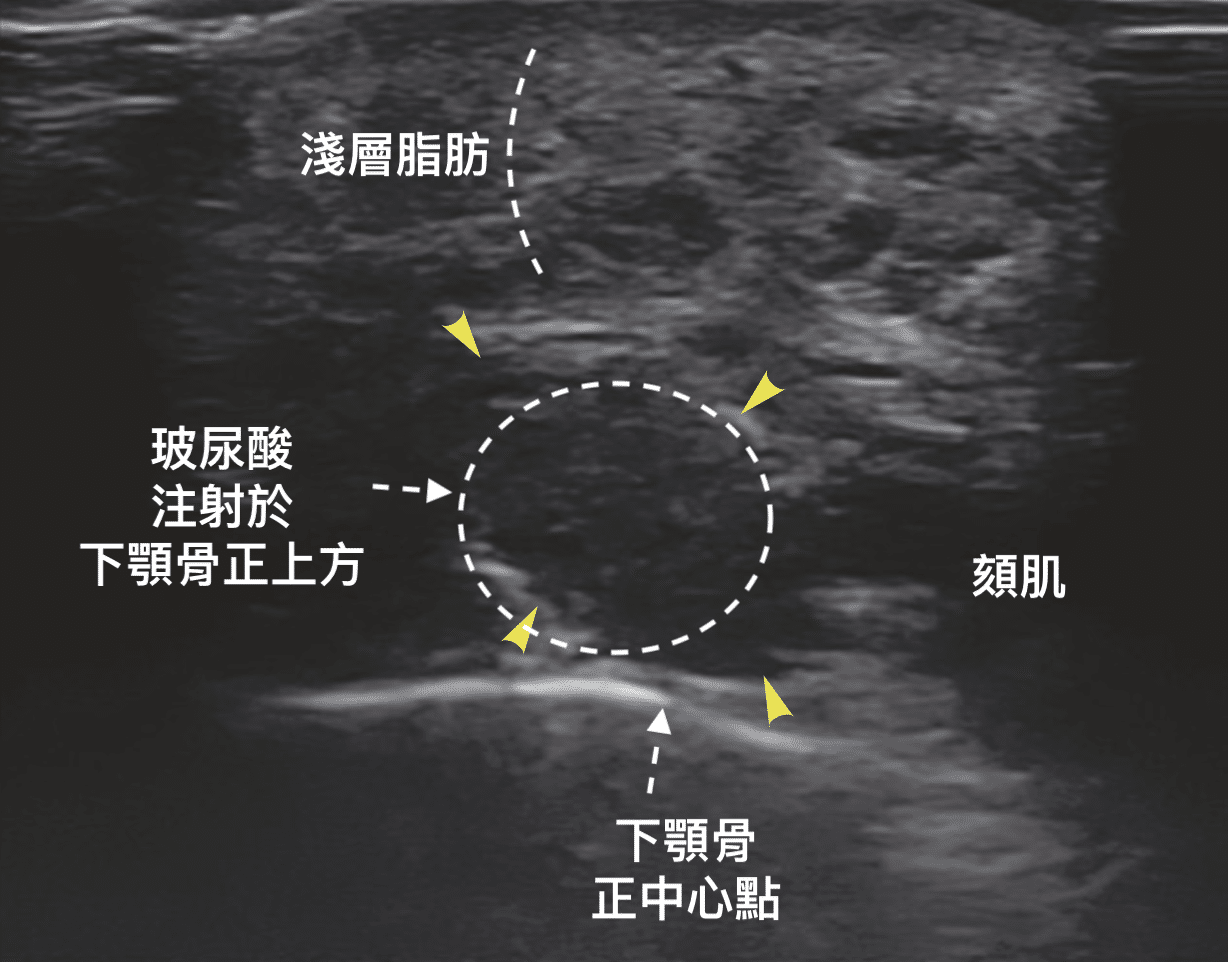Screenshot 2023 08 03 at 12.20.43 金蘋果美學診所｜歐家宏醫師親自諮詢｜無痛玻尿酸｜埋線拉提｜肉毒｜微整｜Goldi Apple
