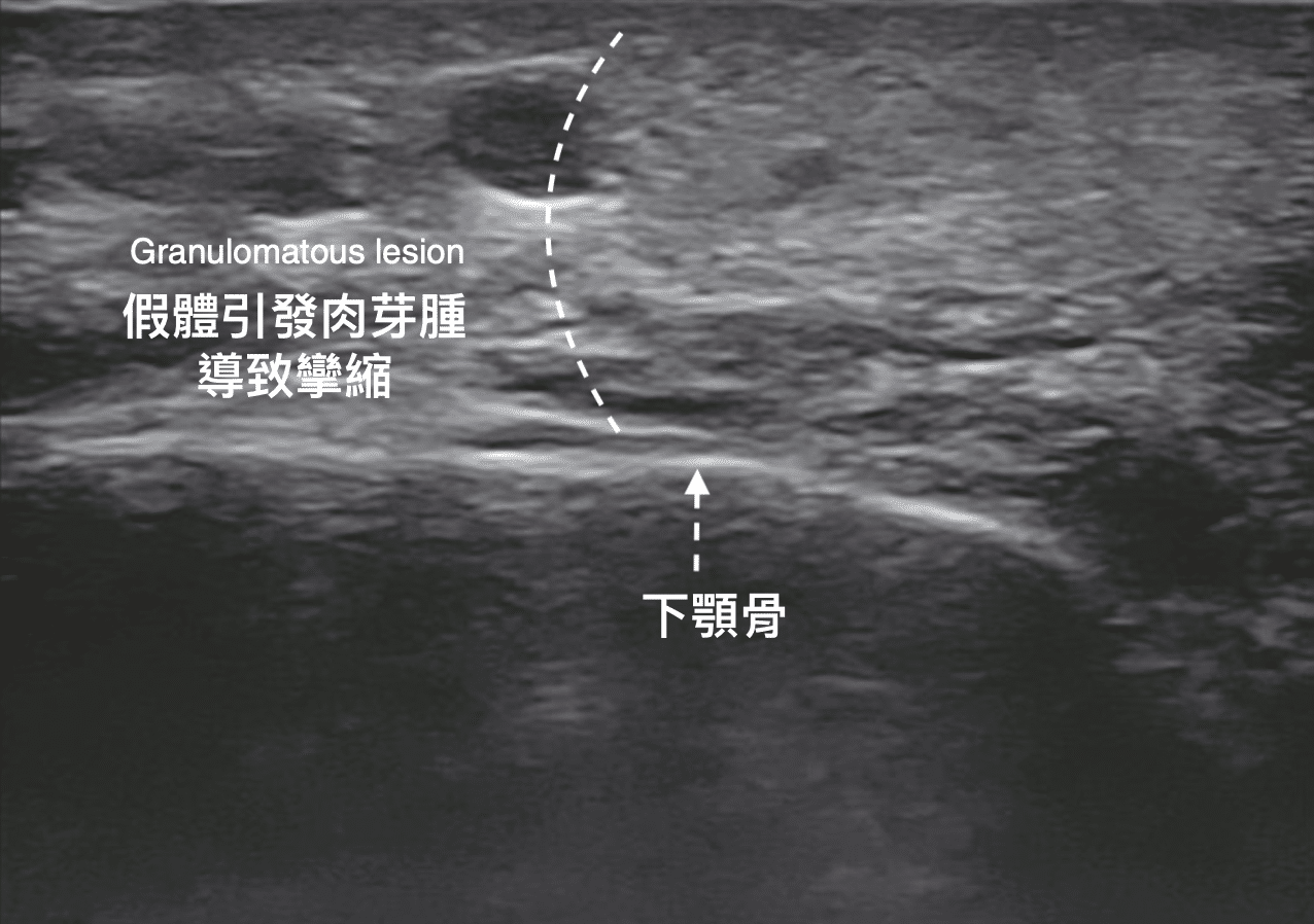 Screenshot 2023 08 03 at 15.20.36 金蘋果美學診所｜歐家宏醫師親自諮詢｜無痛玻尿酸｜埋線拉提｜肉毒｜微整｜Goldi Apple
