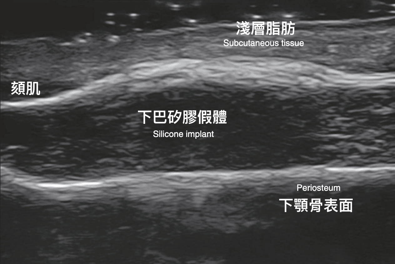 image 24 金蘋果美學診所｜歐家宏醫師親自諮詢｜無痛玻尿酸｜埋線拉提｜肉毒｜微整｜Goldi Apple