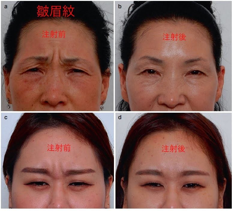 肉毒桿菌除皺3部位全攻略:安全、自然減齡秘訣 2 皺眉 金蘋果美學診所|歐家宏醫師親自諮詢|無痛玻尿酸|埋線拉提|肉毒|微整|Goldi Apple