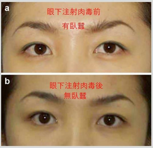 肉毒桿菌除皺3部位全攻略:安全、自然減齡秘訣 3 眼下 金蘋果美學診所|歐家宏醫師親自諮詢|無痛玻尿酸|埋線拉提|肉毒|微整|Goldi Apple