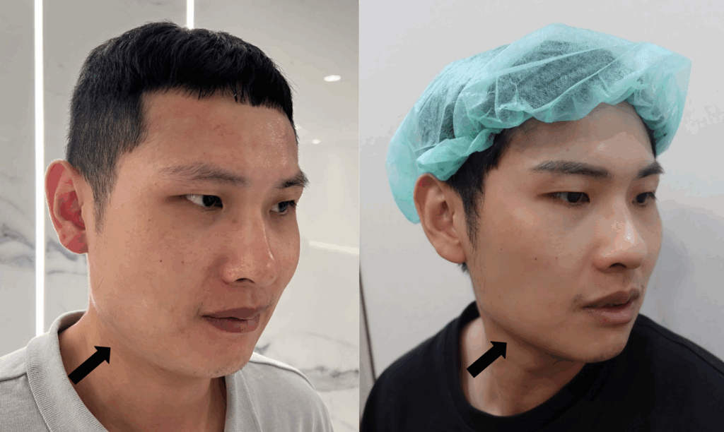 下顎線不明顯怎麼辦?3種下顎線醫美打造完美側臉 5 下顎線肉毒