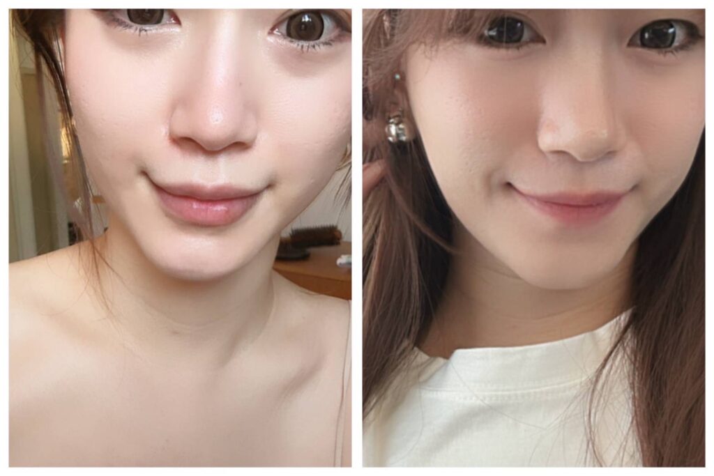 微笑唇玻尿酸