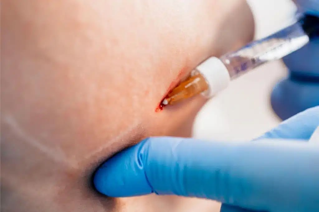 alamy Painless and safe intradermal injections are effective for correcting mimic and senile wrinkles including nasolabial triangle folds 3 金蘋果美學診所｜歐家宏醫師