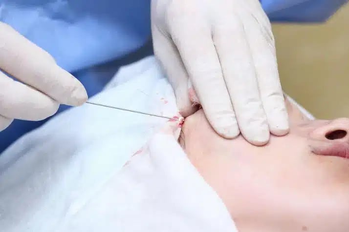 alamy Procedure of face lifting surgery 2 canva 金蘋果美學診所｜歐家宏醫師