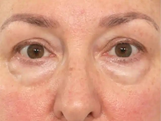 google Eyebags canva 金蘋果美學診所｜歐家宏醫師