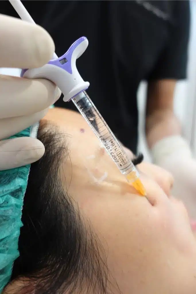 vivi hollow cheek volift 1 金蘋果美學診所｜歐家宏醫師