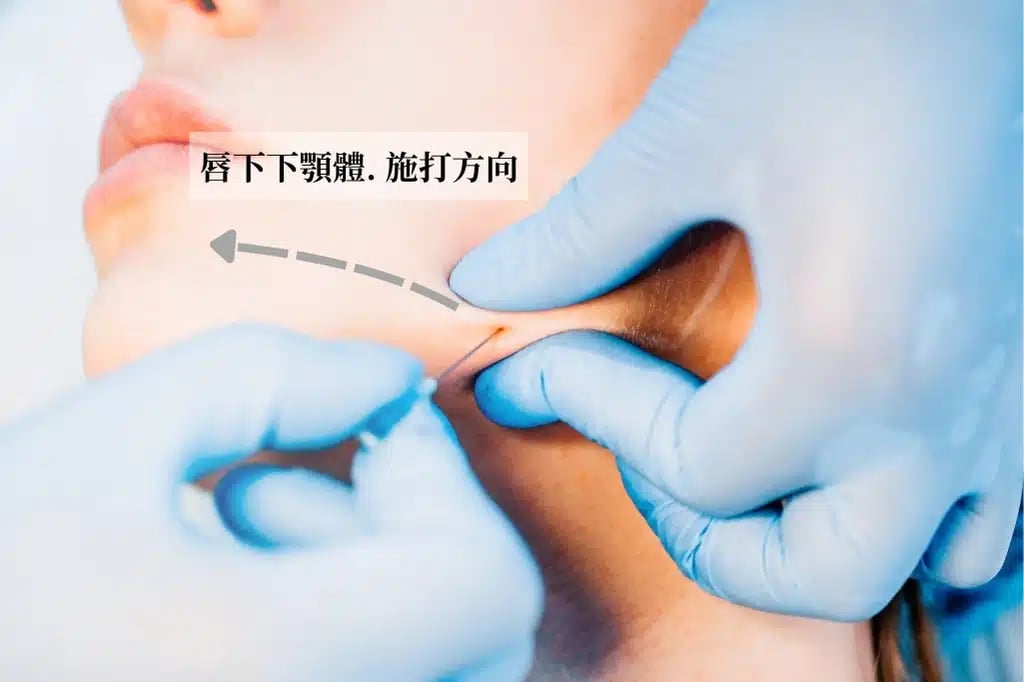 唇下下顎體. 施打方向 canva 1 金蘋果美學診所｜歐家宏醫師