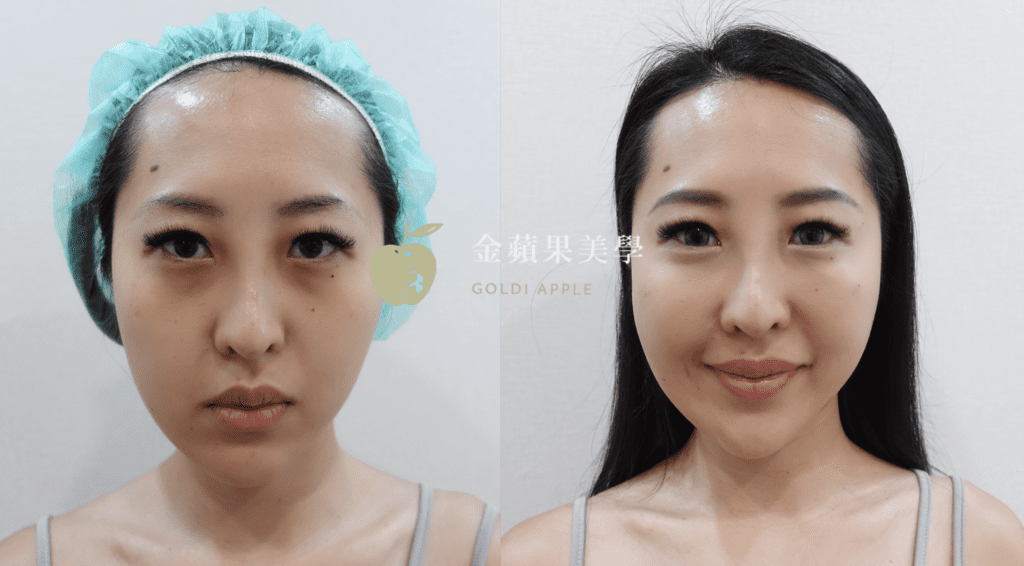 淚溝醫美推薦打什麼?3種類型淚溝改善千萬別搞錯 3 淚溝玻尿酸
