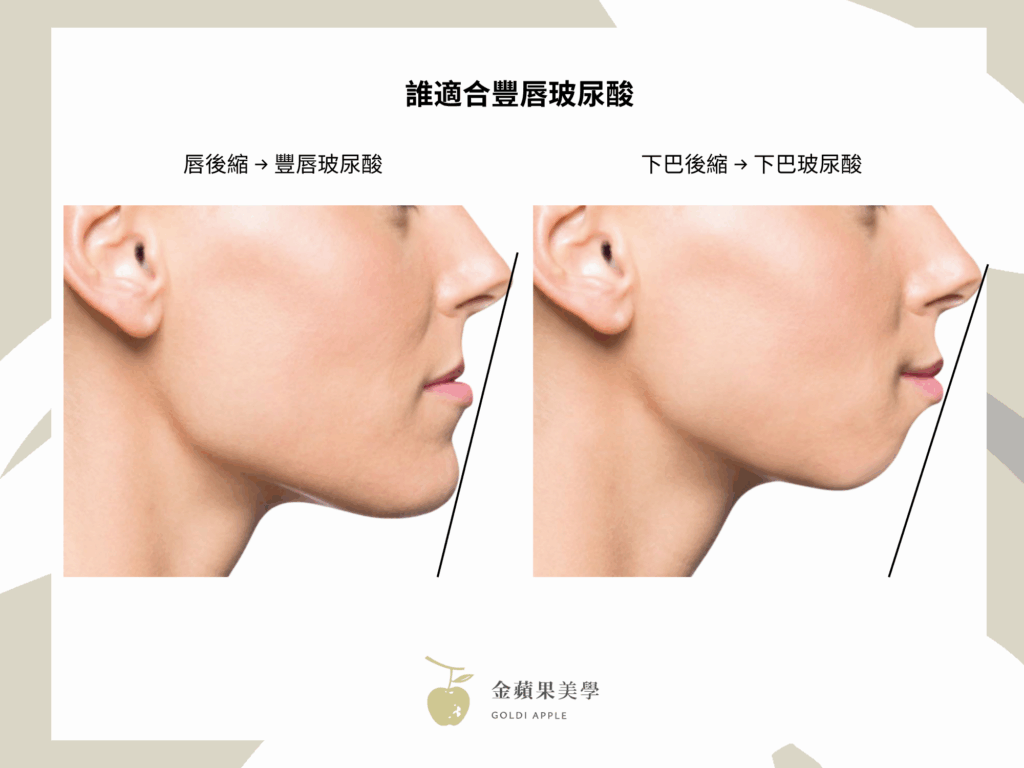 豐唇玻尿酸打造魅力自我:3種唇型哪種適合我 2 誰適合豐唇玻尿酸 金蘋果美學診所|歐家宏醫師
