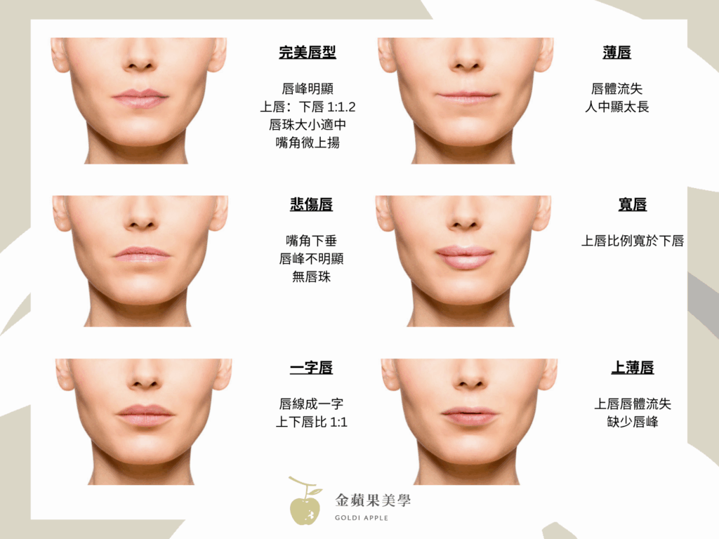 豐唇玻尿酸打造魅力自我:3種唇型哪種適合我 3 豐唇玻尿酸
