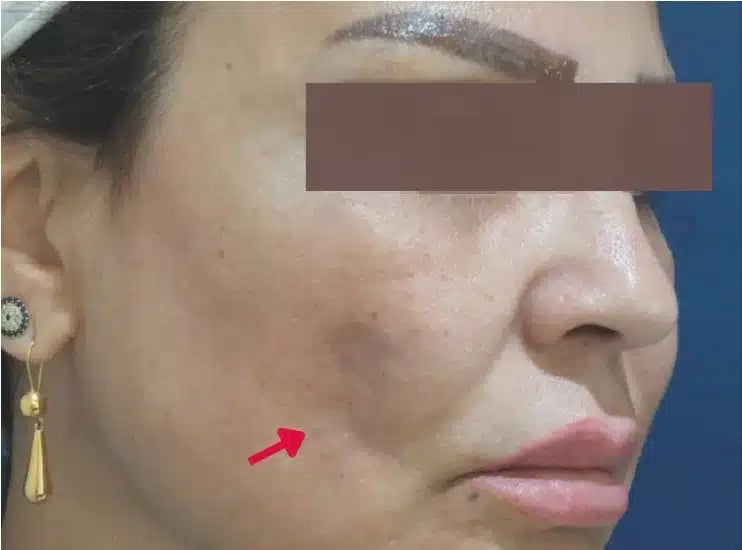 20240705 嘴邊肉凹canva editted 金蘋果美學診所｜歐家宏醫師