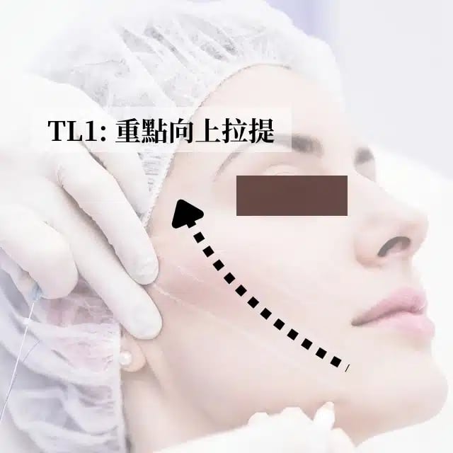 TL1 重點向上拉提 金蘋果美學診所｜歐家宏醫師