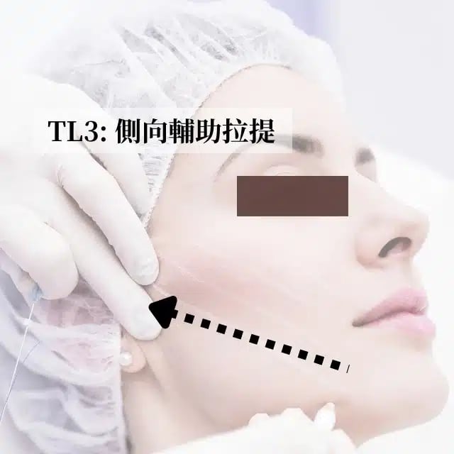TL3 側向輔助拉提 金蘋果美學診所｜歐家宏醫師