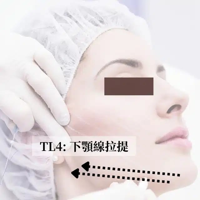 TL4 下顎線拉提 金蘋果美學診所｜歐家宏醫師
