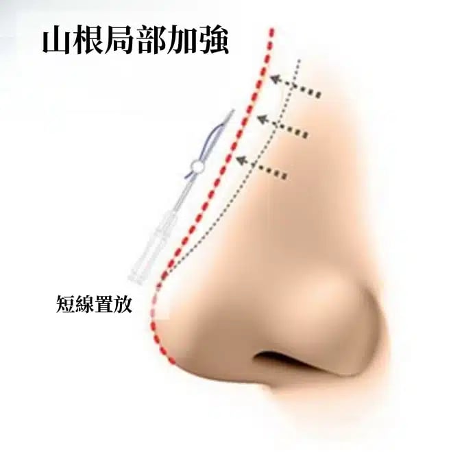 鼻雕