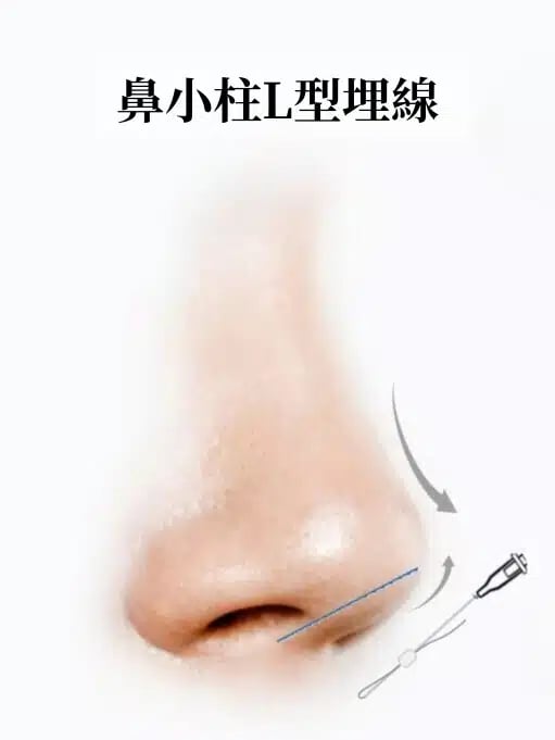 鼻小柱L型埋線 金蘋果美學診所｜歐家宏醫師