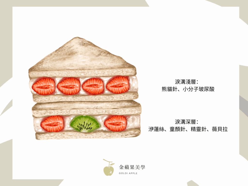 淚溝醫美推薦打什麼?3種淚溝類型千萬別搞錯 6 三明治淚溝