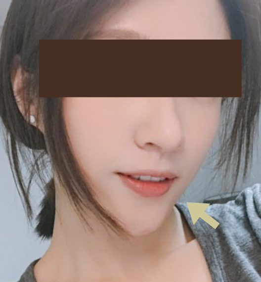 下巴玻尿酸搶救短下巴:2種玻尿酸品牌推薦 15 下巴太尖 金蘋果美學診所|歐家宏醫師