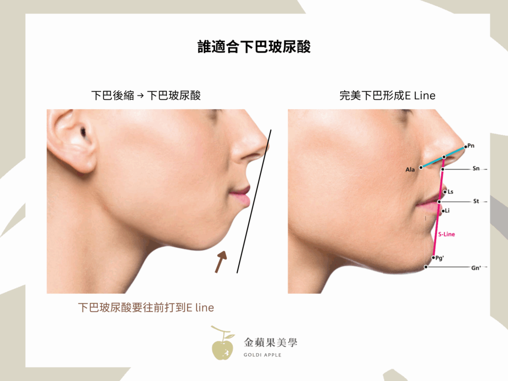 下巴玻尿酸搶救短下巴:2種玻尿酸品牌推薦 1 下巴後縮
