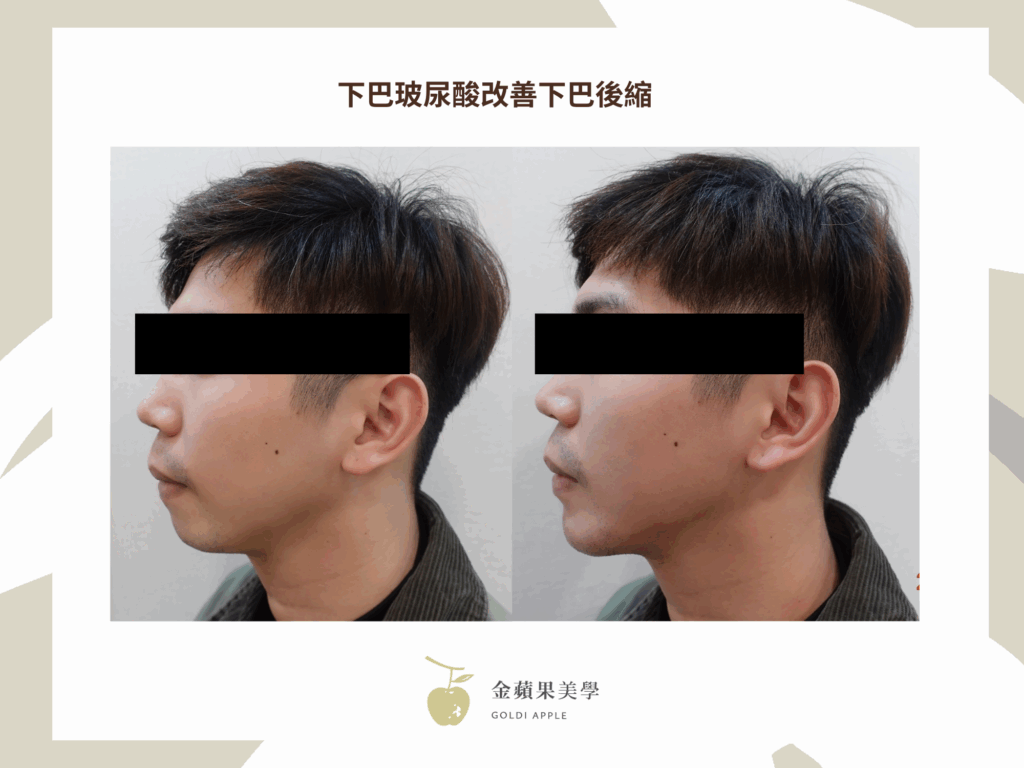下巴玻尿酸搶救短下巴:2種玻尿酸品牌推薦 3 沒有下巴