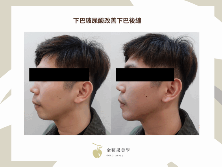 下巴玻尿酸搶救短下巴:2種玻尿酸品牌推薦 1 下巴玻尿酸 金蘋果美學診所|歐家宏醫師
