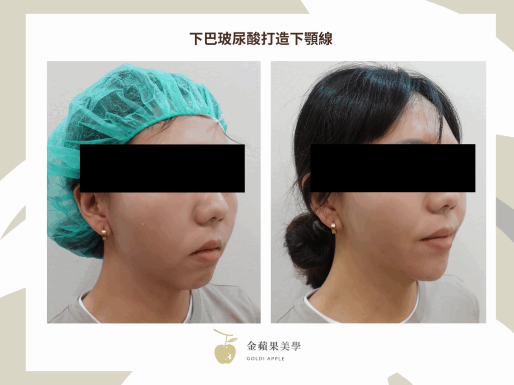 下巴玻尿酸搶救短下巴:2種玻尿酸品牌推薦 5 下顎線