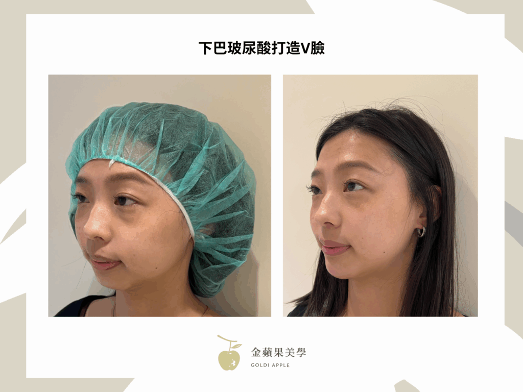 下巴玻尿酸搶救短下巴:2種玻尿酸品牌推薦 11 下巴玻尿酸幾cc