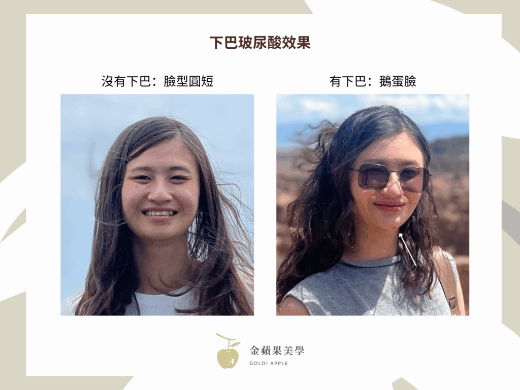 下巴玻尿酸搶救短下巴:2種玻尿酸品牌推薦 4 下巴玻尿酸維持多久