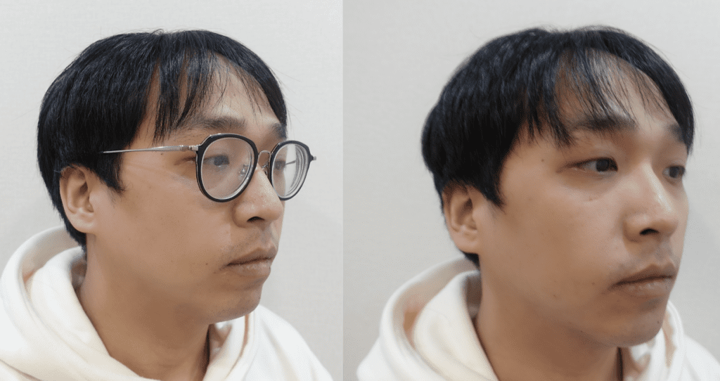 改善下巴後縮