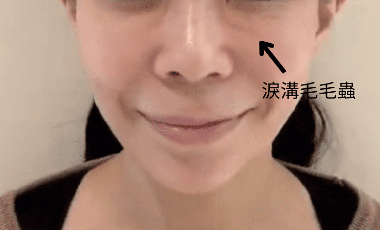 淚溝失敗