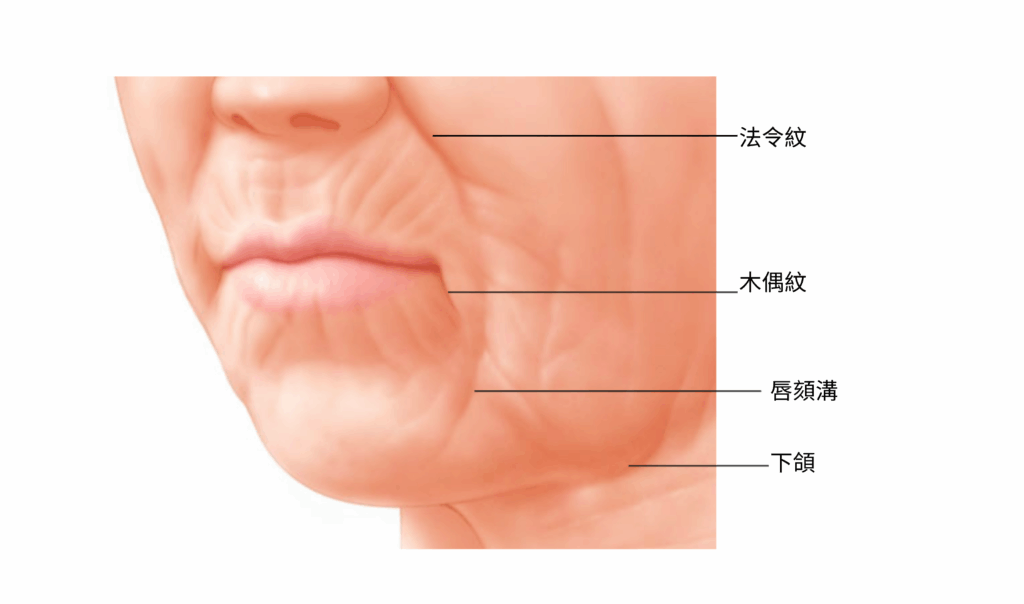 木偶紋消除