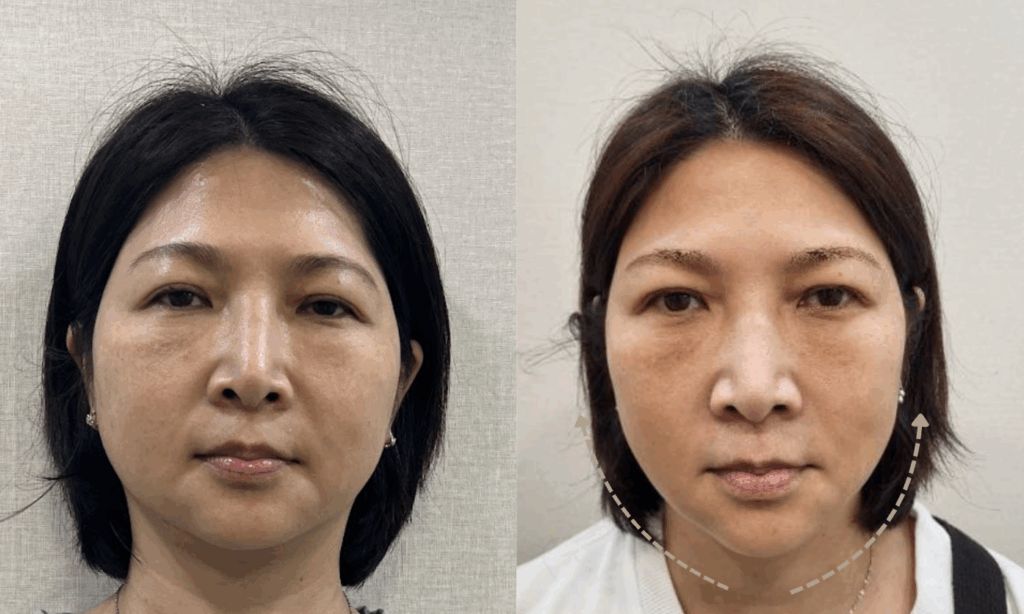 法令紋醫美最佳解:2種法令紋複合式治療 8 埋線拉提BA照 金蘋果美學診所|歐家宏醫師親自諮詢|無痛玻尿酸|埋線拉提|肉毒|微整|Goldi Apple