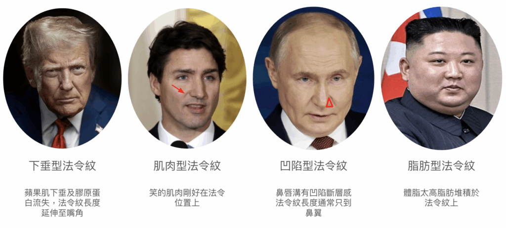 法令紋醫美最佳解:2種法令紋類型複合式治療 1 法令紋類型