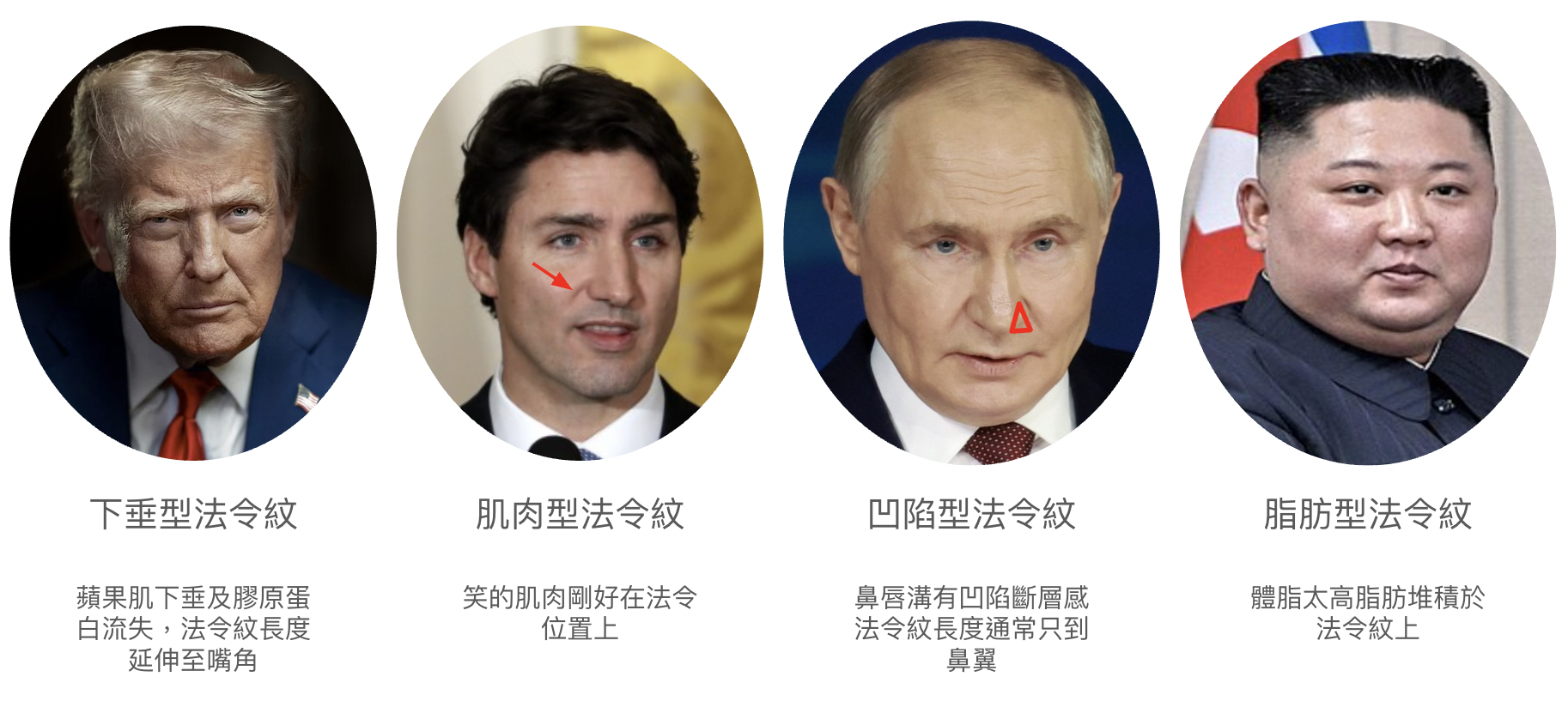 法令紋消除都沒效?4種不同類型法令紋改善方式 1 法令紋種類 1 金蘋果美學診所|歐家宏醫師