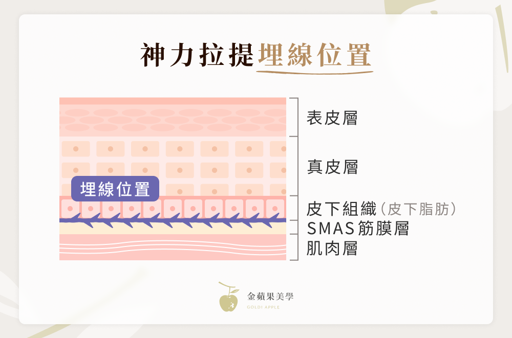 神力拉提效果好嗎?線材優勢、費用、案例分享,讓你告別鬆弛下垂 2 神力拉提埋線位置