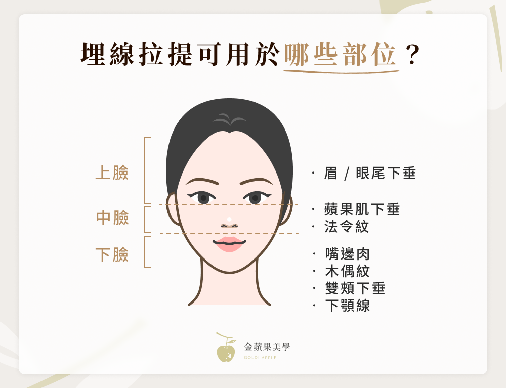 埋線拉提是什麼?只需30分鐘,讓你的肌膚緊實有感! 2 埋線拉提可用於哪些部位