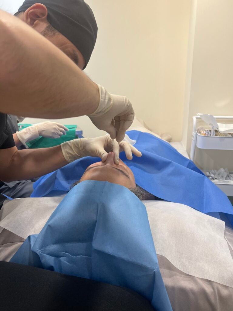 鼻雕缺點這麼多嗎?鼻子微整2種方式比一比 4 鼻小柱埋線