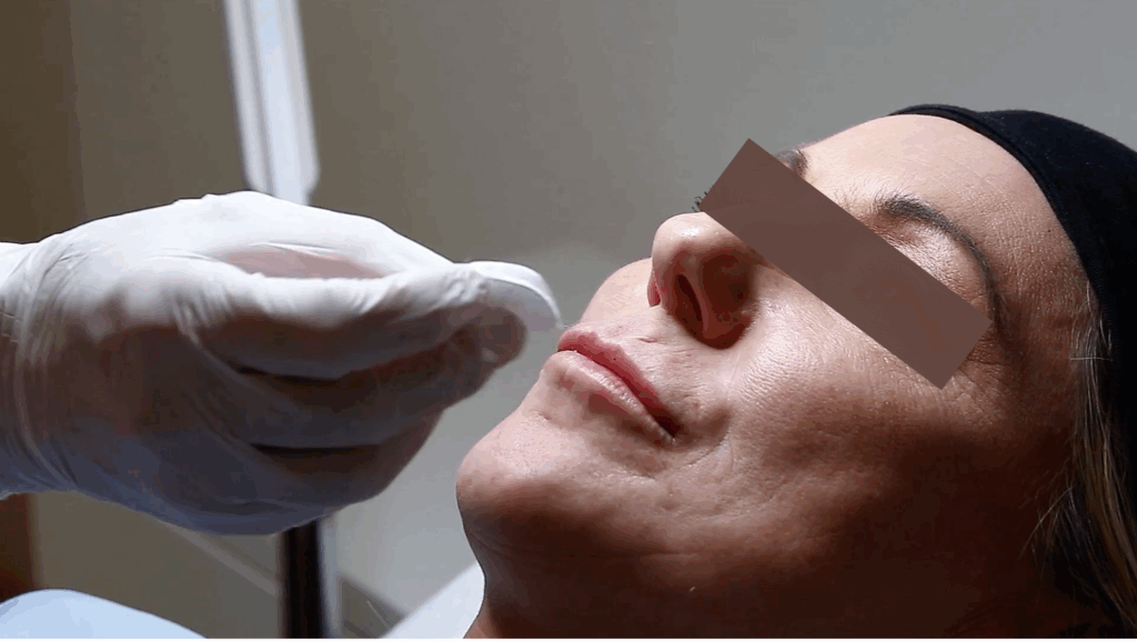 嘴唇黃金救援:極精度調整唇型& 調整不對稱 2 cupids bow freshup technique2 M shape 1 金蘋果美學診所|歐家宏醫師