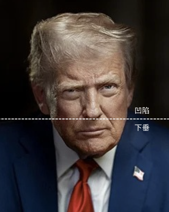 鼻基底凹陷如何改善?4種法令紋填充材質分析、價錢 1 法令紋成因 金蘋果美學診所|歐家宏醫師