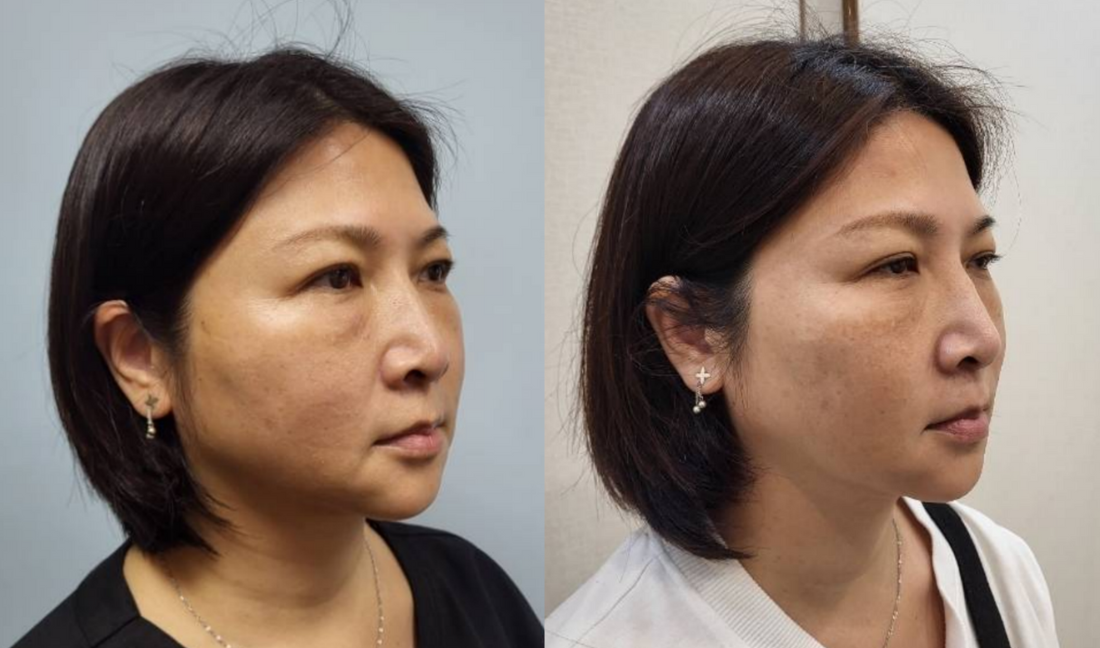 無痕筋膜提升費用要多少?一文解析無痕筋膜療程種類、效果與價格 5 金蘋果美學診所案例 1:改善法令紋&木偶紋
