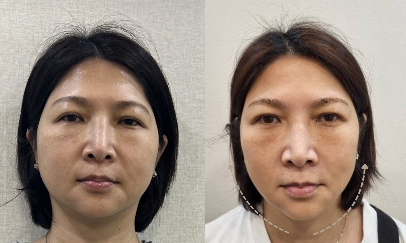 無痕筋膜提升費用要多少?一文解析無痕筋膜療程種類、效果與價格 6 金蘋果美學診所案例 1:改善法令紋&木偶紋