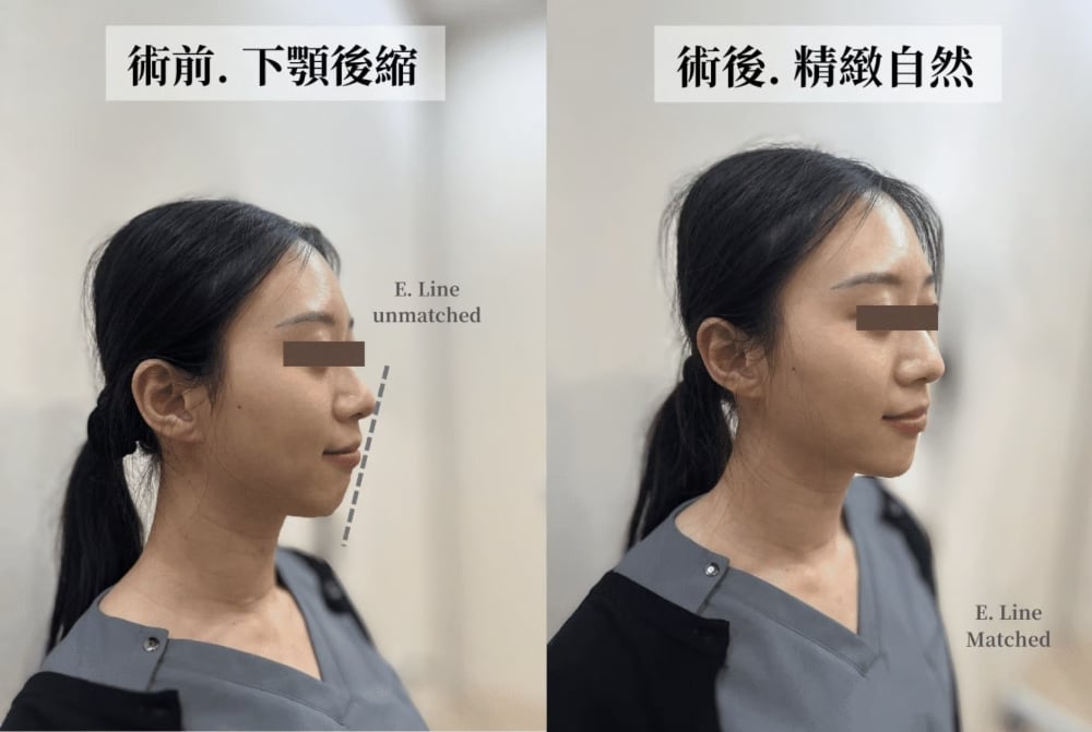 喬雅登玻尿酸是什麼?適合部位、維持時間 3 金蘋果美學診所案例 2:打造美觀線(E-Line)
